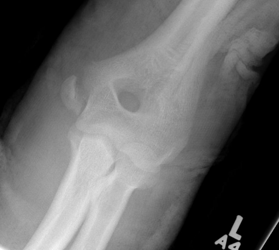 Medial Epicondyle Fracture